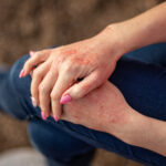 Close up dermatitis on skin. Copyright: InfiniteStudio - stock.adobe.com