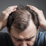 Symbolbild „Haarausfall“. (A man with hair fall health problem holding his hair to reveals bald head. Concept of aging fallen hair health breaking falling problem.) Copyright: ribah – stock.adobe.com