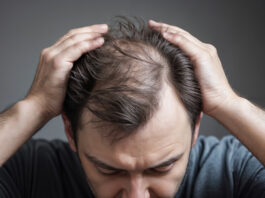 Symbolbild „Haarausfall“. (A man with hair fall health problem holding his hair to reveals bald head. Concept of aging fallen hair health breaking falling problem.) Copyright: ribah – stock.adobe.com